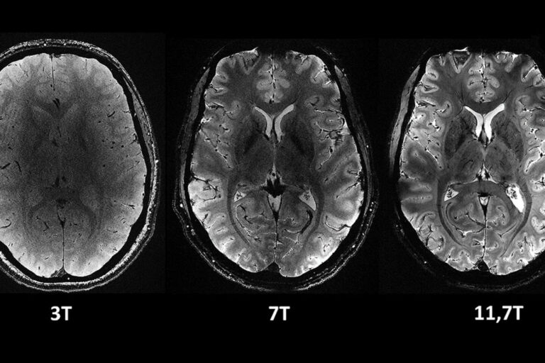 The brain under the eye of the most powerful MRI in the world
